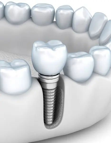 Ilustración de un implante dental con su corona